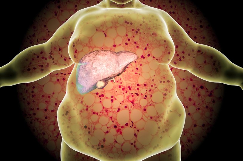 Niealkoholowe stłuszczenie wątroby (NAFLD) według szacunków może dotyczyć nawet 1/4 Polaków /123RF/PICSEL