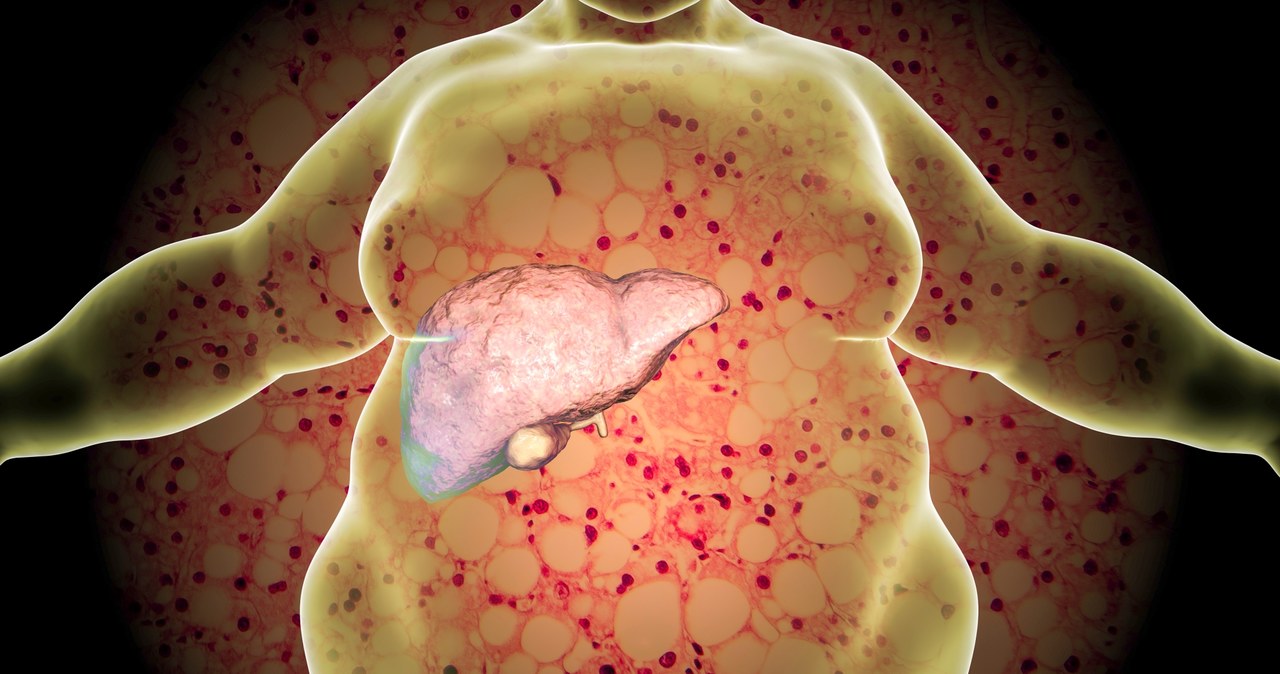 Niealkoholowe stłuszczenie wątroby (NAFLD) według szacunków może dotyczyć nawet 1/4 Polaków /123RF/PICSEL