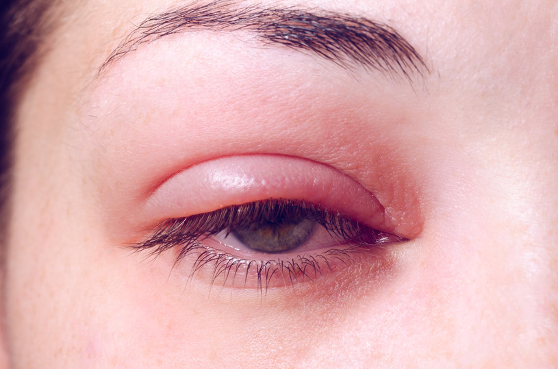 Niedobór witaminy D ma negatywny wpływ na wzrok. Do tego dochodzą bóle głowy i drgawki /123RF/PICSEL