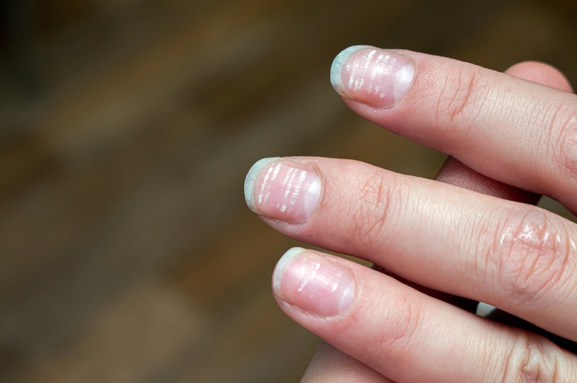 Niedobór żelaza osłabia paznokcie, które stają się kruche i łamliwe /123RF/PICSEL