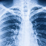 Niektórzy chorzy na COVID-19 mają "czyste" płuca