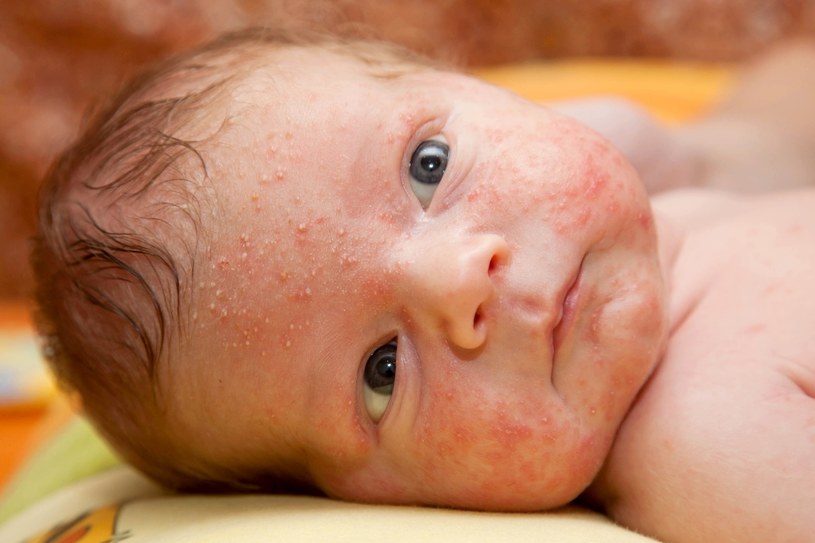 Niemowlęca skóra często nękana jest przez różne problemy dermatologiczne /123RF/PICSEL