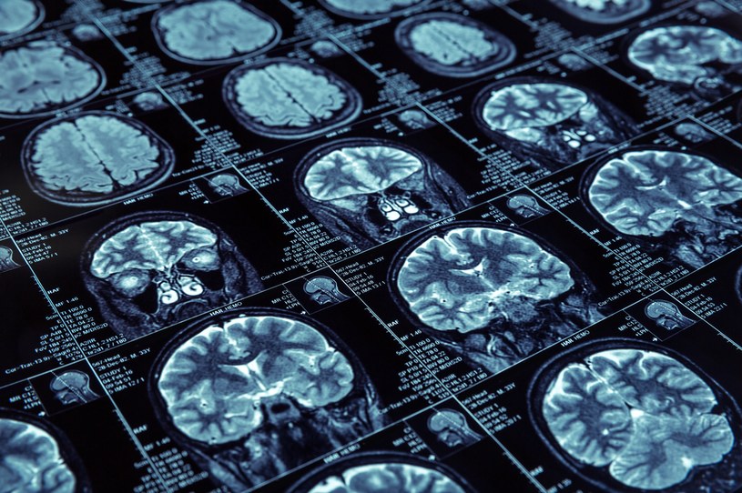 Nieoczywisty sygnał, iż rozwija się choroba Alzheimera. Nowe dane