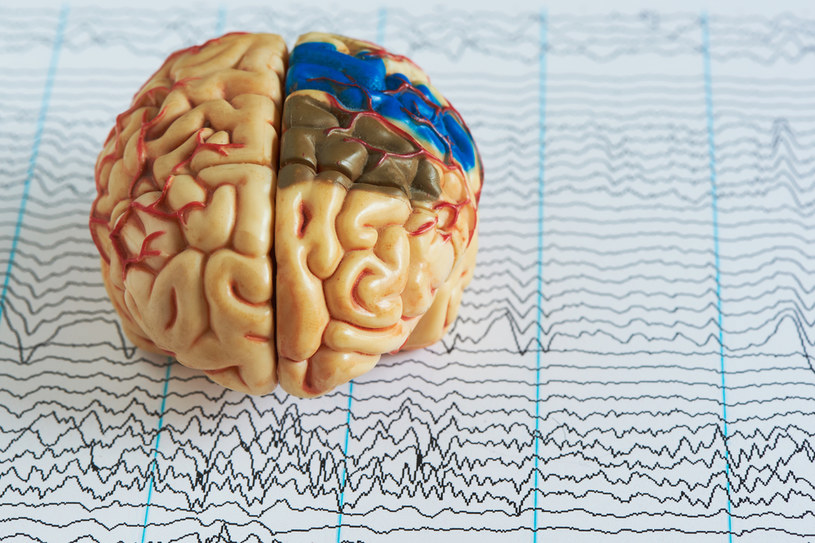 Nieprawidłowy wynik badania EEG może świadczyć o rozwijającym się guzie mózgu lub urazie /123RF/PICSEL
