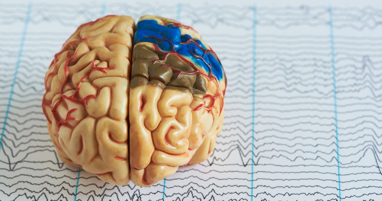 Nieprawidłowy wynik badania EEG może świadczyć o rozwijającym się guzie mózgu lub urazie /123RF/PICSEL