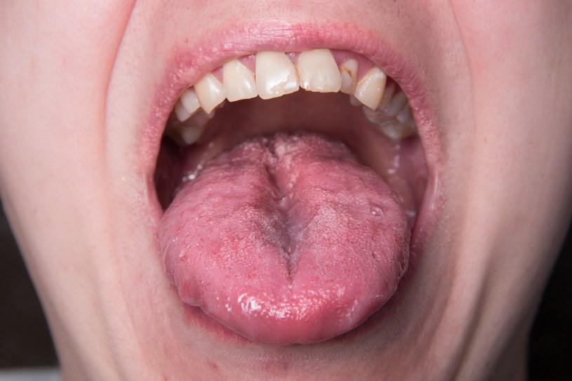 Nieprzyjemne pieczenie w ustach może być wynikiem kandydozy, cukrzycy czy przyjmowania niektórych leków /123RF/PICSEL