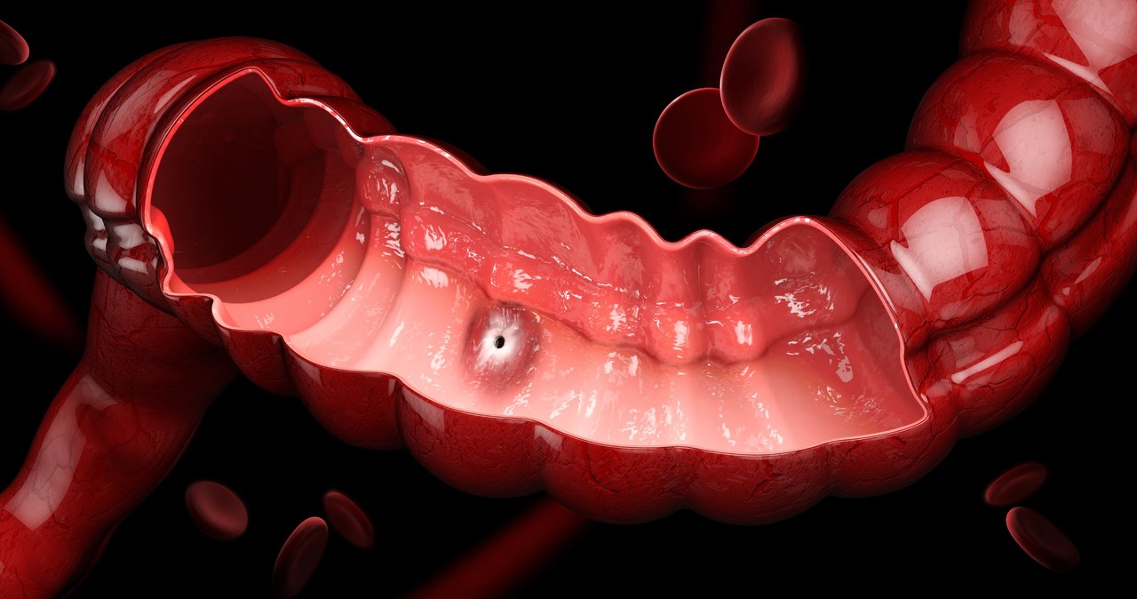 Niewłaściwa dieta może prowadzić do wielu chorób jelit, w tym nowotworów /123RF/PICSEL
