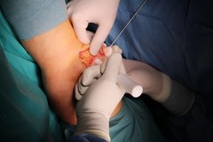 Nowatorska operacja wszczepienia bioplantu rzepki
