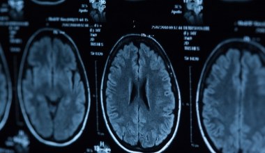 Nowe fakty o mózgu psychopatów. Odkryto wyraźne różnice biologiczne