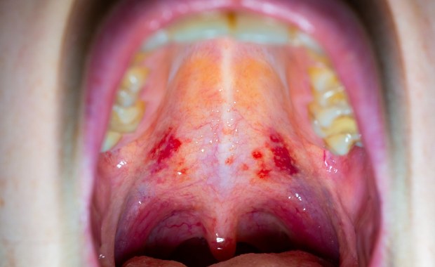 Nowe warianty COVID-19. Nietypowe objawy, "gardło jak pocięte żyletkami"