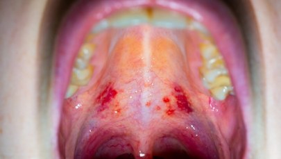 Nowe warianty COVID-19. Nietypowe objawy, "gardło jak pocięte żyletkami"