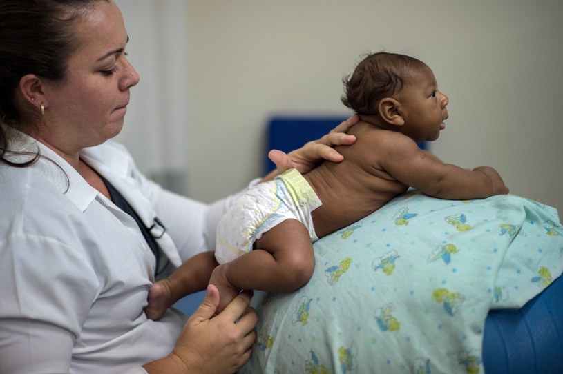 Noworodek cierpiący na mikrocefalię, przypadłość wywołaną wirusem Zika /AFP