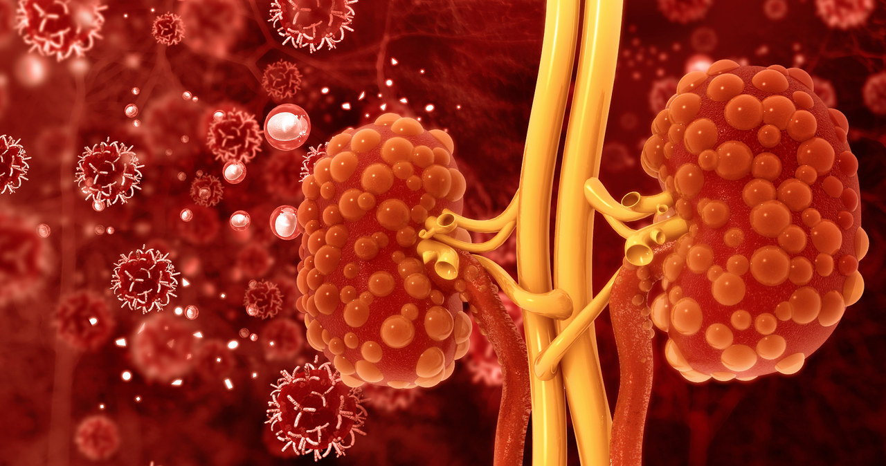 Nowotwór nerek często ma postać złośliwą ze skłonnością do przerzutów odległych /123RF/PICSEL
