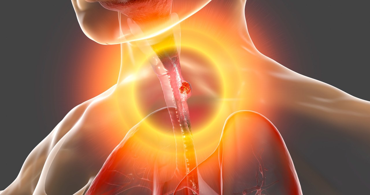 Nowotwór przełyku długo nie daje specyficznych objawów, dlatego wykrywany jest zazwyczaj późno, co przekłada się na złe rokowanie /123RF/PICSEL