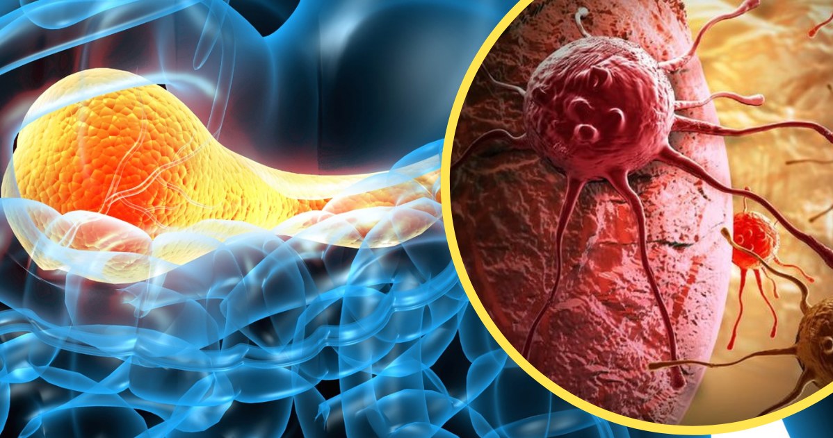Nowotwór trzustki jest rakiem o złym rokowaniu, prawie 90 proc. pacjentów umiera pomimo wdrożonego leczenia /123RF/PICSEL