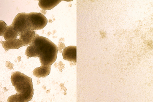 Nowotworowe komórki macierzyste (po lewej) i te same komórki zniszczone przez wirus Zika (po prawej) /Zhe Zhu /Materiały prasowe