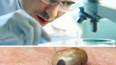 Nowy antybiotyk wyeliminuje boreliozę? 