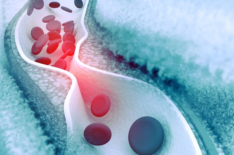 Nowy sposób na obniżenie poziomu cholesterolu we krwi /123RF/PICSEL