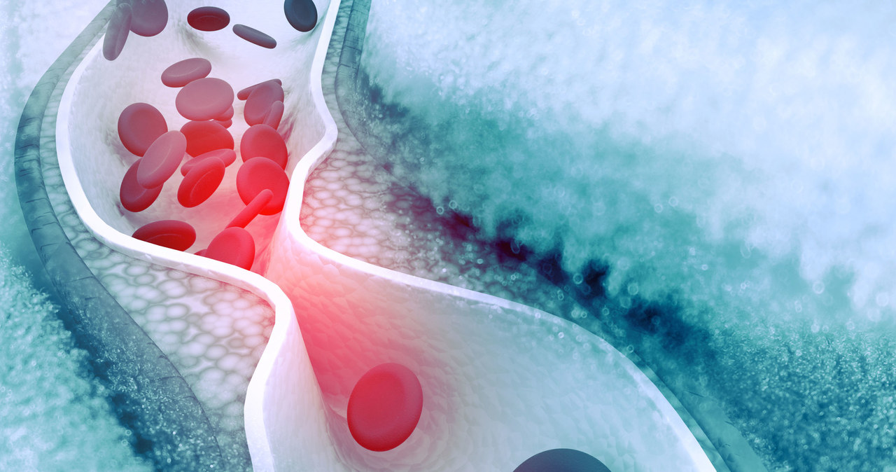 Nowy sposób na obniżenie poziomu cholesterolu we krwi /123RF/PICSEL