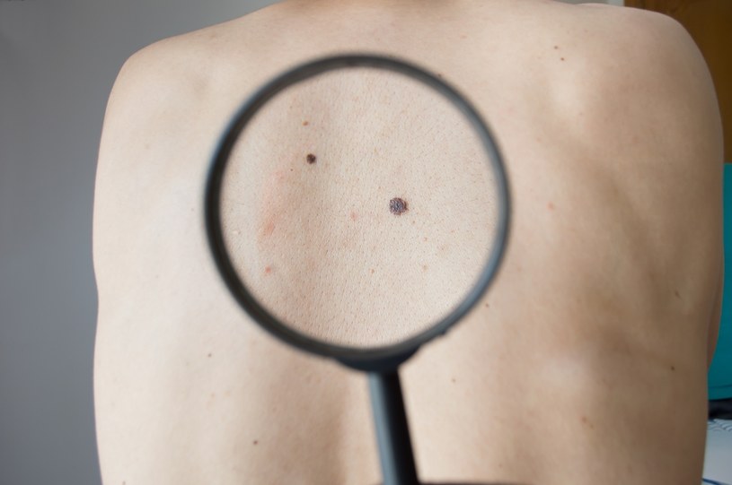 Nowy sposób na walkę z rakiem skóry? /123RF/PICSEL