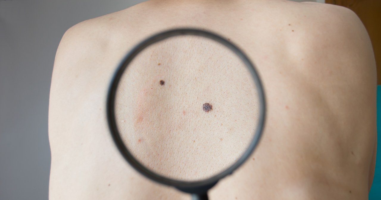 Nowy sposób na walkę z rakiem skóry? /123RF/PICSEL