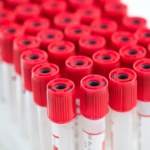 O czym warto pamiętać przed badaniami krwi? Co należy, a czego nie powinno się robić