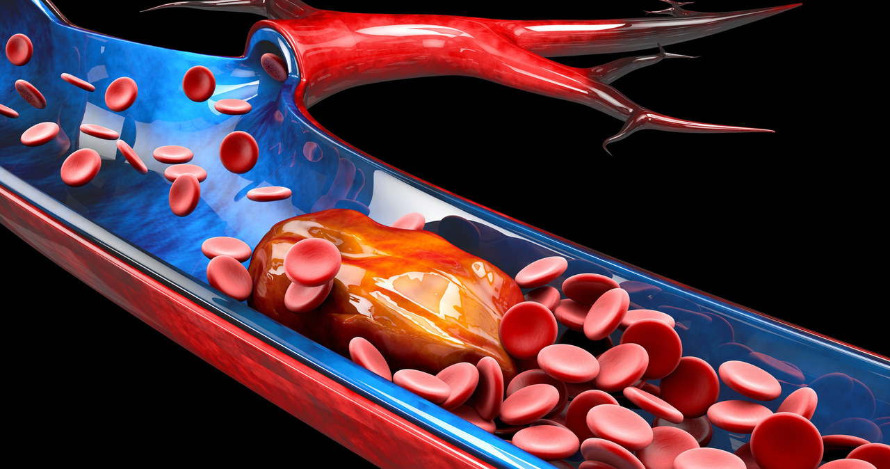 Obecność skrzeplin w naczyniach żylnych uniemożliwia powrót krwi do serca i uszkadza zastawki żylne /123RF/PICSEL