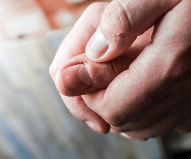 Obgryzanie paznokci. Cichy sygnał ukrytych problemów emocjonalnych