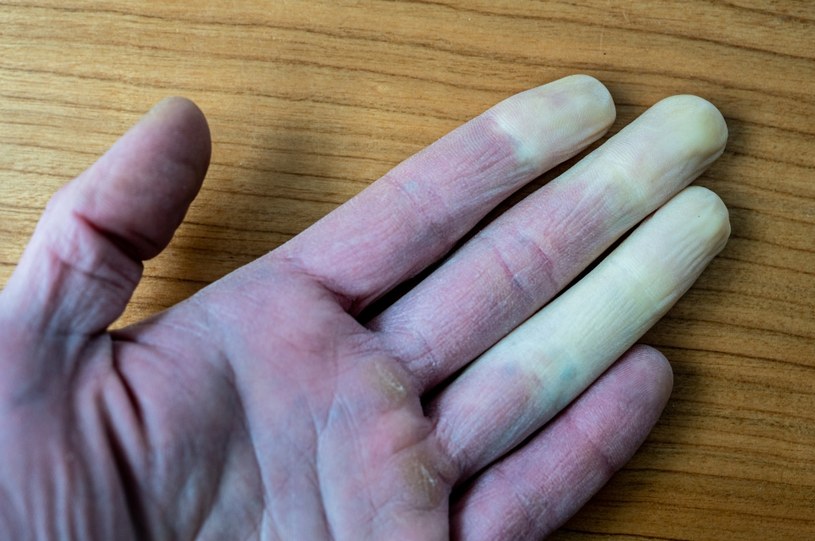 Objaw Raynauda zazwyczaj nie obejmuje kciuka, jest widoczny na pozostałych palcach ręki /123RF/PICSEL