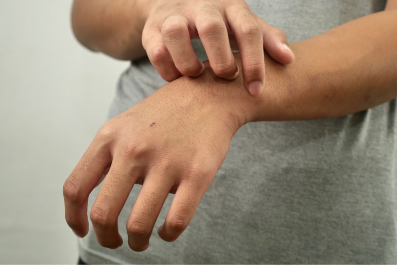 Objawem chorób wątroby może być m.in. swędzenie skóry. Wyjaśniamy, jakie jeszcze sygnały ze strony skóry mogą się pojawić, gdy wątroba choruje /123RF/PICSEL