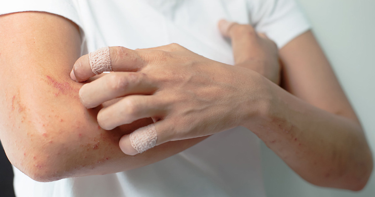 Objawy atopowego zapalenia skóry mogą nasilać się pod wpływem nieprawidłowej diety /123RF/PICSEL