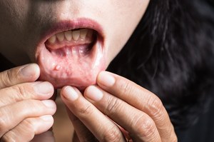 Objawy raka jamy ustnej. Są cztery sygnały ostrzegawcze
