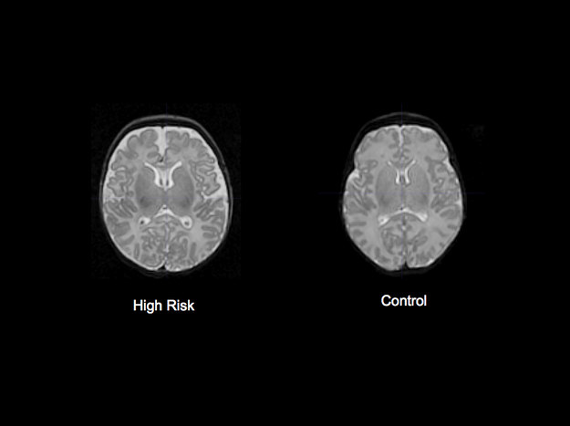 Obraz mózgu po lewej wykazuje powiększenie komór bocznych &nbsp; /Fot. John Gilmore, MD