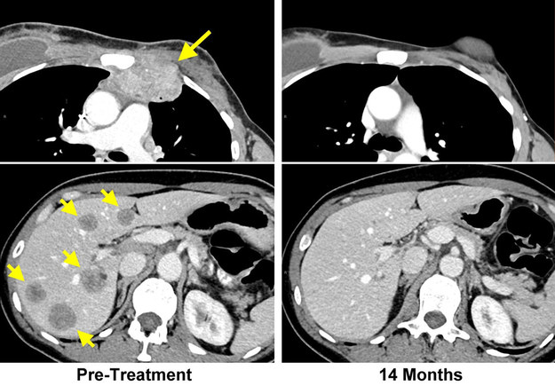 Obraz NMR przed terapią (po lewej, strzałkami wskazano tkankę nowotworową, w tym przerzuty do wątroby) i po terapii (po prawej) / National Cancer Institute /Materiały prasowe