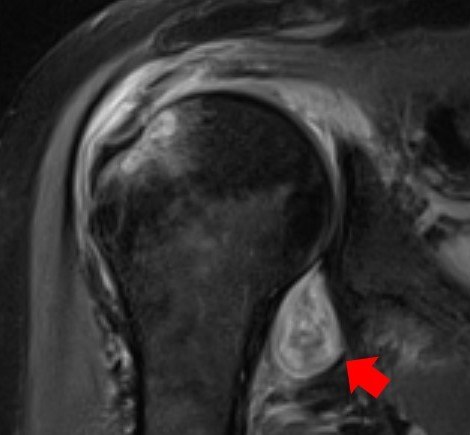 Obraz NMR ramienia pacjenta, u którego koronawirus przyczynił się do reumatycznego zapalenia stawów. Strzałką oznaczono miejsce objęte procesem zapalnym /Northwestern University /Materiały prasowe