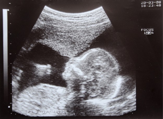 Obraz płodu podczas badania USG w 19. tygodniu ciąży /Barbara Ostrowska    /PAP