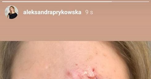 Obrażenia, jakich doznała Aleksandra Prykowska, wyglądały bardzo groźnie /Instagram /materiały prasowe