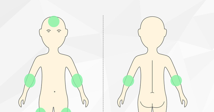 Obrażenia na ciele powstające na ogół w wyniku normalnych aktywności i zabaw /INTERIA.PL