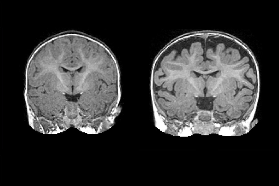 Obrazy mózgu dziecka w wieku pół roku. Po prawej, mózg dziecka, u którego w wieku 2 lat zdiagnozowano autyzm /Carolina Institute for Developmental Disabilities (UNC-Chapel Hill) /materiały prasowe