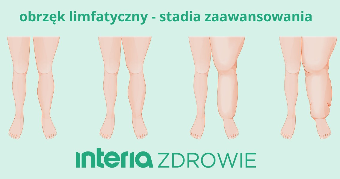 Obrzęk limfatyczny narasta, stopniowo odbierając zdrowie i sprawność /123RF/PICSEL