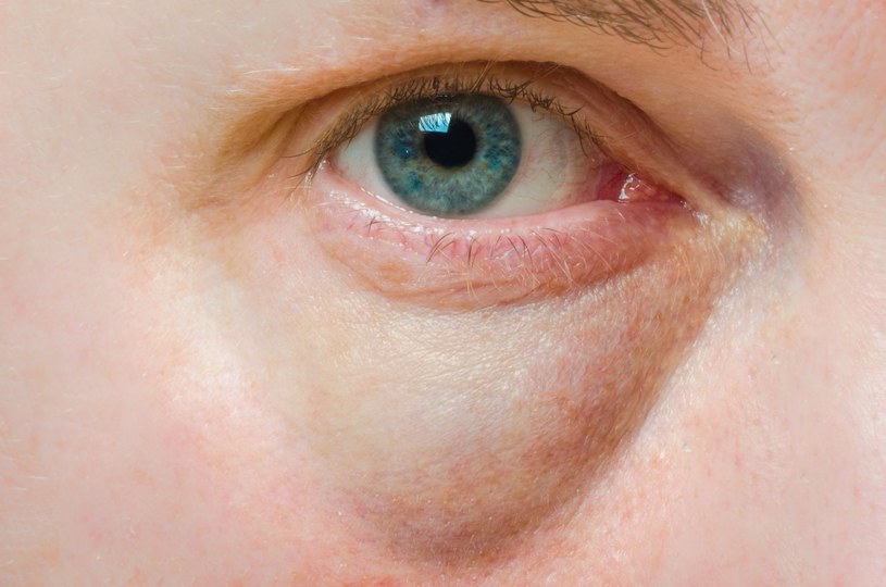 Obrzęki oczu mogą być objawem poważnej choroby /123RF/PICSEL