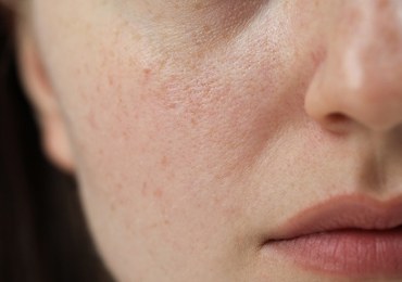 Ochłodzenie na horyzoncie. Jak przygotować naszą skórę?