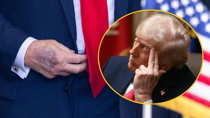 Od siniaków po problemy ze snem. Trump o tym, dlaczego ignoruje zalecenia lekarzy