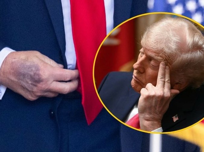 Od siniaków po problemy ze snem. Trump o tym, dlaczego ignoruje zalecenia lekarzy