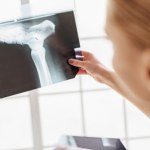 Odkryli "czujnik ćwiczeń" w kościach. Przełom w walce z osteoporozą?