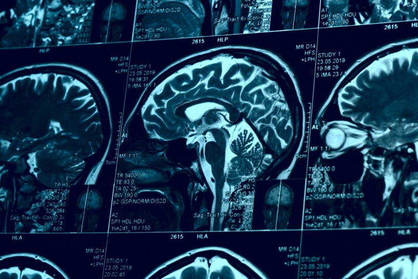 Odkryto nową chorobę, która „wysysa” witaminę B z mózgu