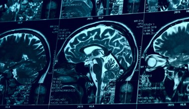 Odkryto nową chorobę, która „wysysa” witaminę B z mózgu