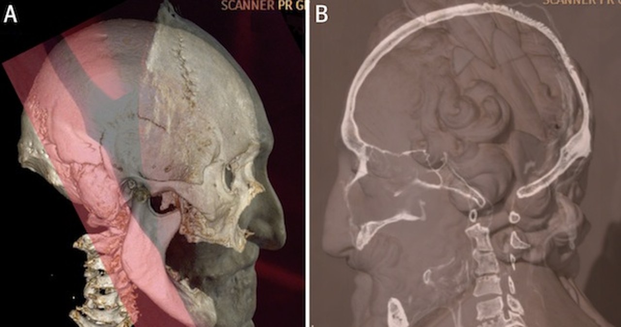 Odnaleziono zabalsamowaną głowę Henryka IV Burbona