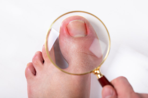 Odpowiednia pielęgnacja stóp to podstawa profilaktyki wrastania paznokci /Shutterstock