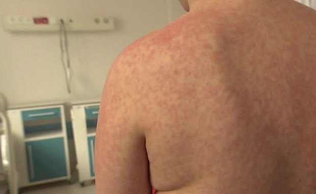 Odra na Pomorzu. Wszyscy chorzy to obywatele Ukrainy